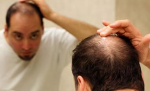 什么是肾虚型脱发？中医治疗肾虚型脱发的偏方有哪些？